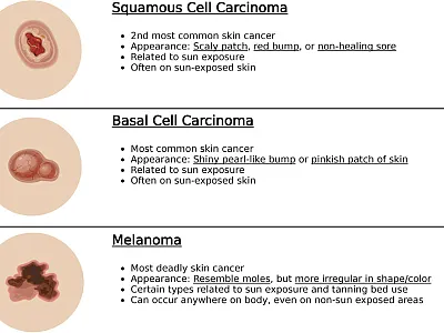 Figure 1. Overview of the three most common skin cancers. Illustration created with Biorender.com.